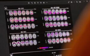 FILE PHOTO: A scientist looks at hypometabolic and hypoperfusion patterns
