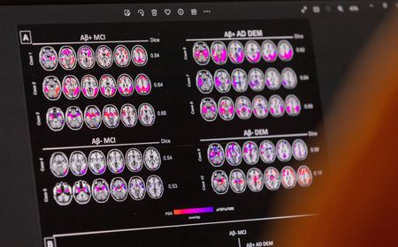 People with two copies of a risk gene have genetic form of Alzheimer’s, scientists say